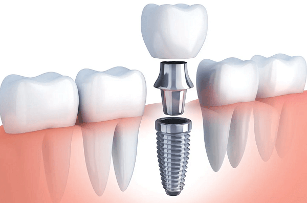 What’s Included in the Dental Implant Pricing Guide