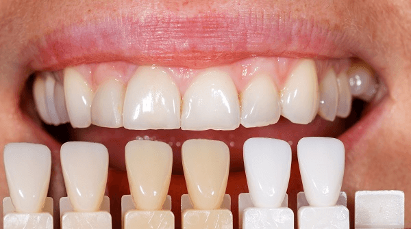 When Should You Use a Dental Shade Guide?