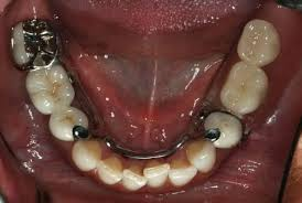 Who Needs Partial Dentures for Back Teeth
