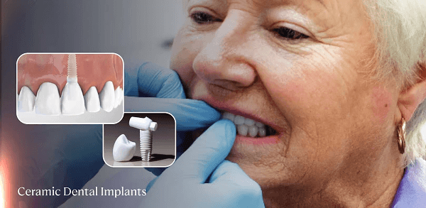 Who Should Consider Ceramic Dental Implants