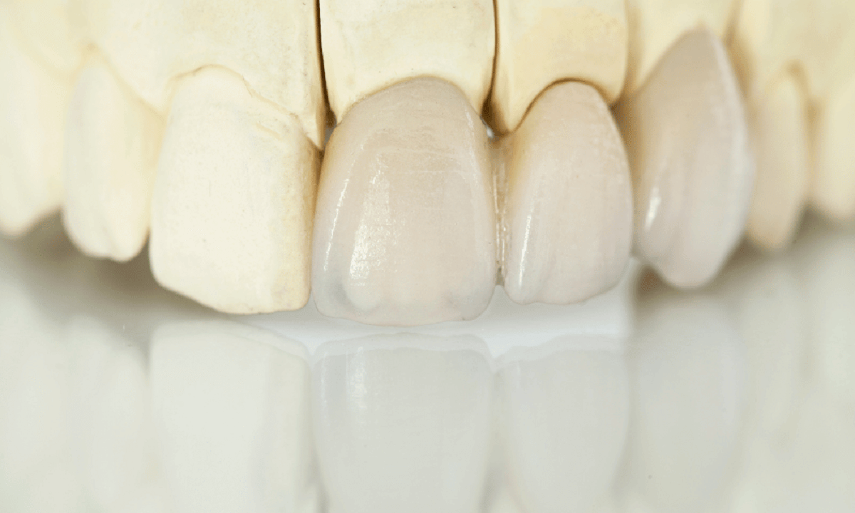 Zirconia Crown Preparation