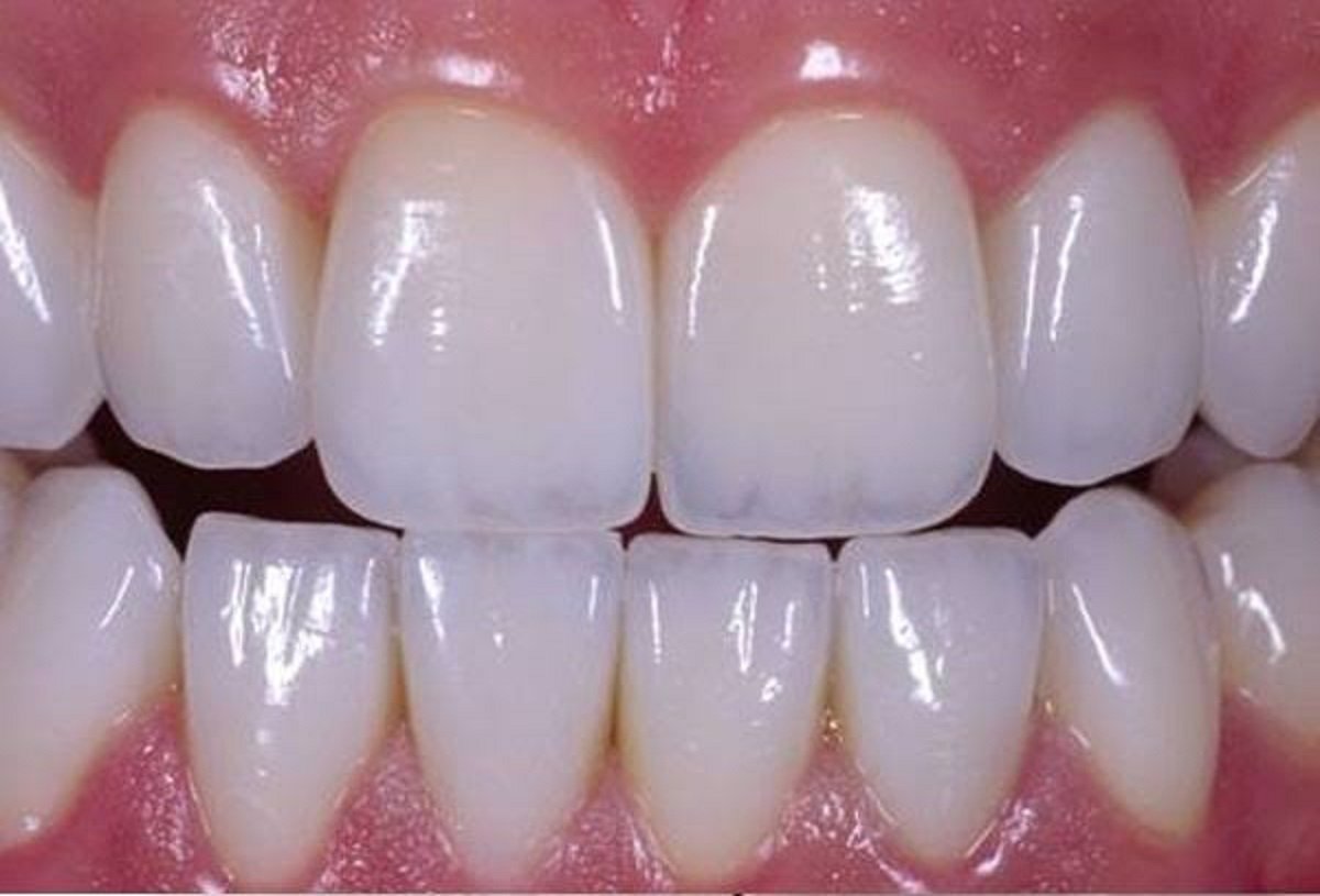 Zirconia Veneers