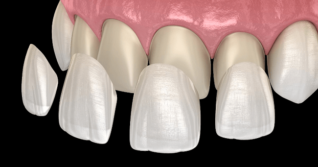 Zirconia Veneers