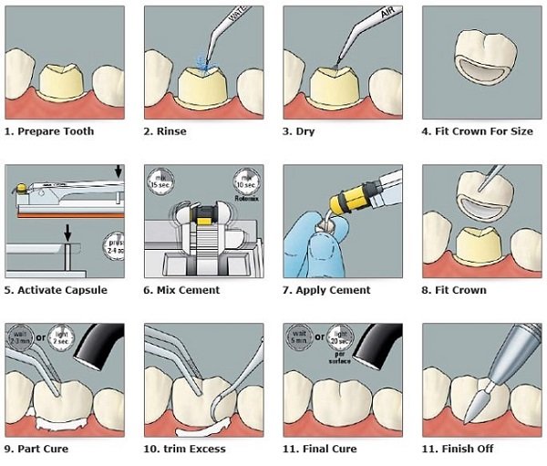 Zirconia bonding steps