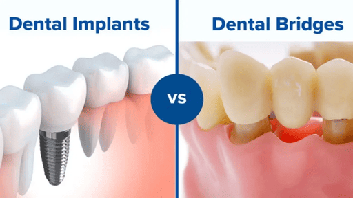 Zirconia dental bridge vs implant