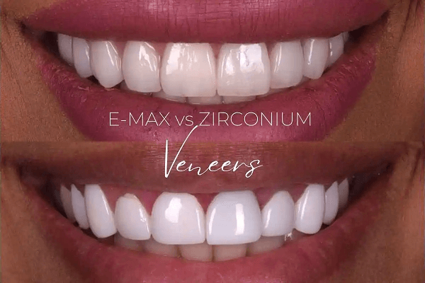 Zirconia vs Emax Veneers