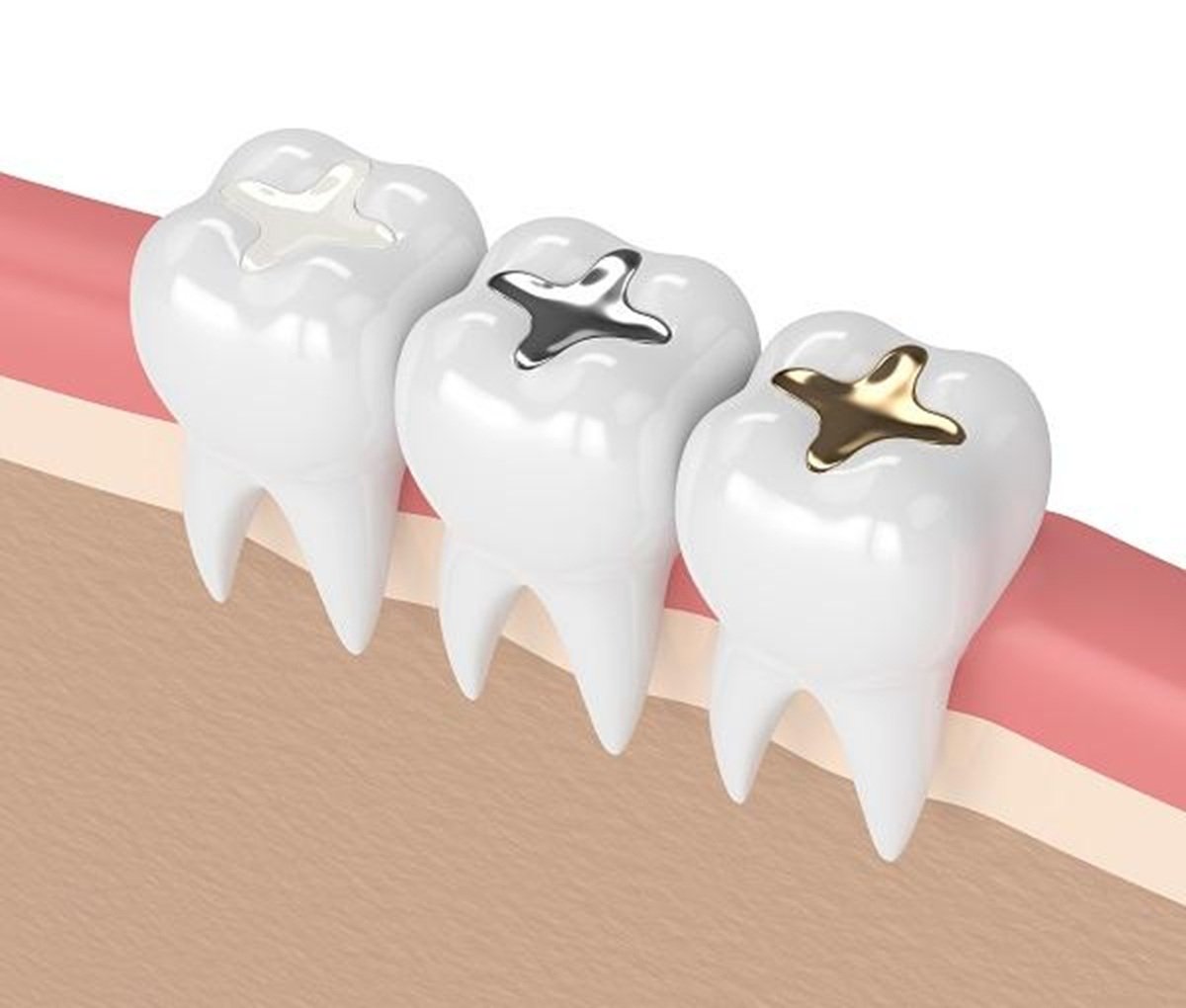 amalgam tooth fillings
