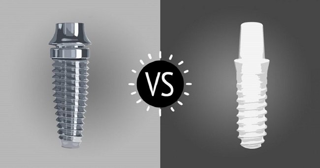 ceramic dental implants vs titanium