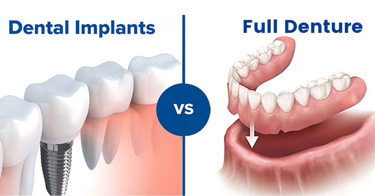 dental implants vs dentures