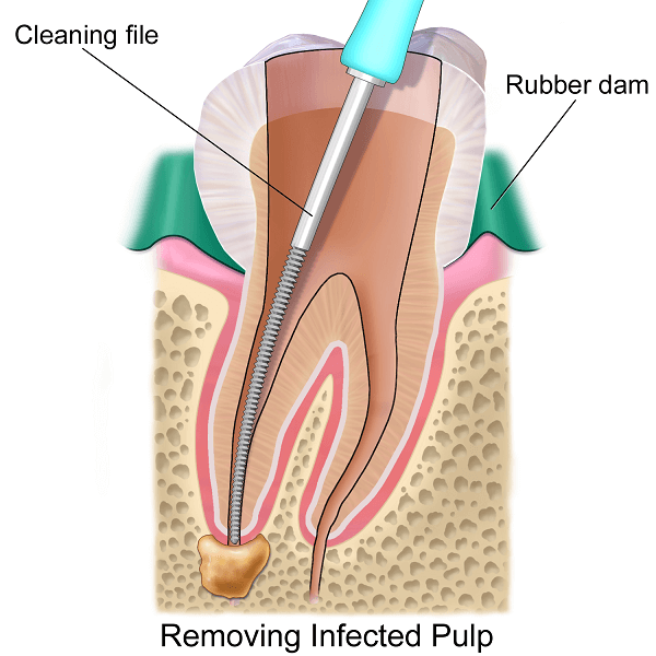 dental root canal infection removal
