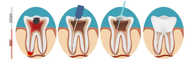 dental root canal pain treatment