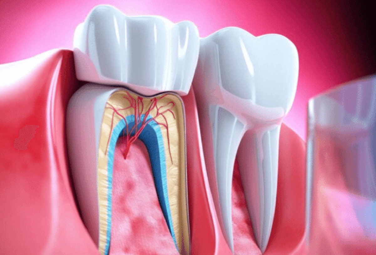 dental root canal treatment