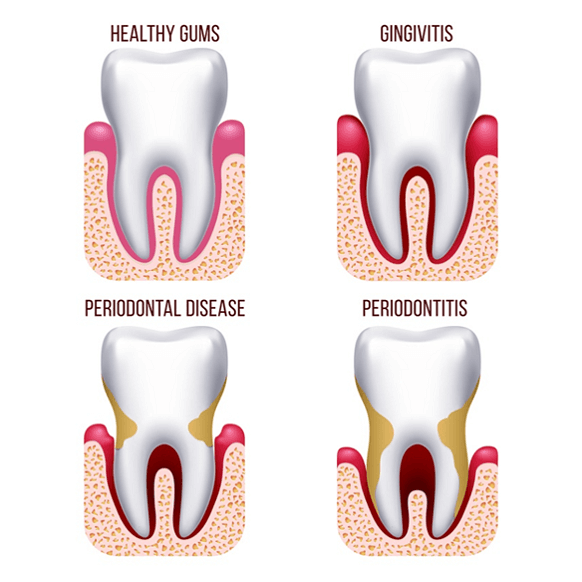 different stages of periodontal disease