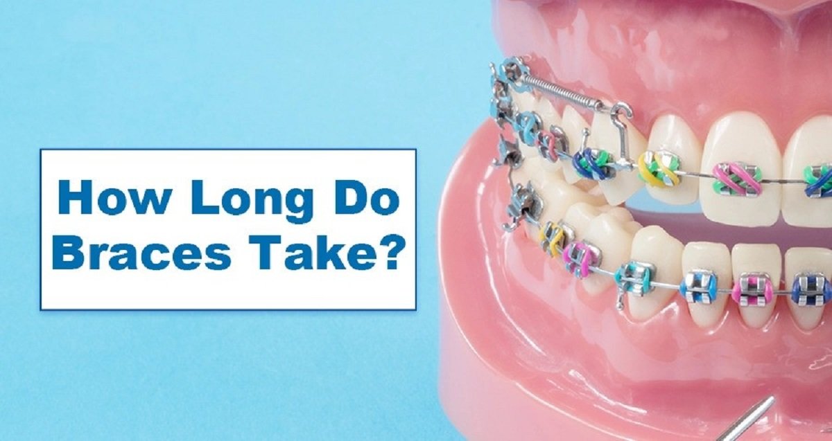 how long do braces take