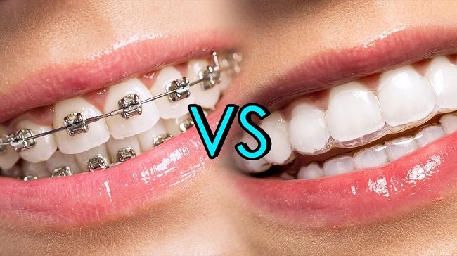 invisible dental braces vs traditional braces