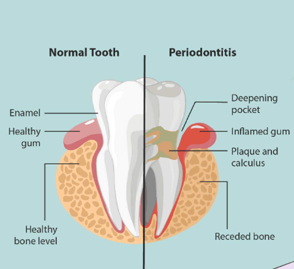 the difference between normal tooth and periodontitis