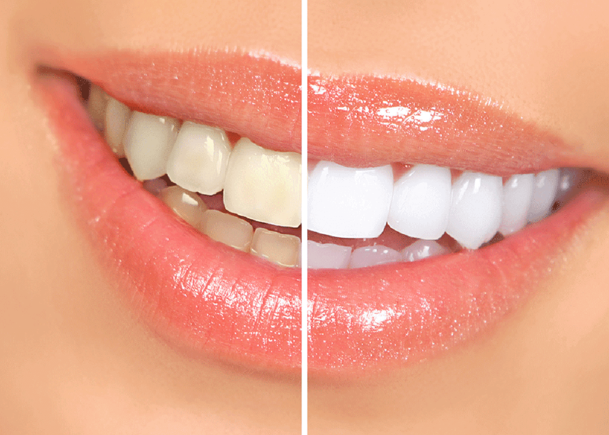 the image shows the before and after dental teeth whitening treatment appearance of teeth