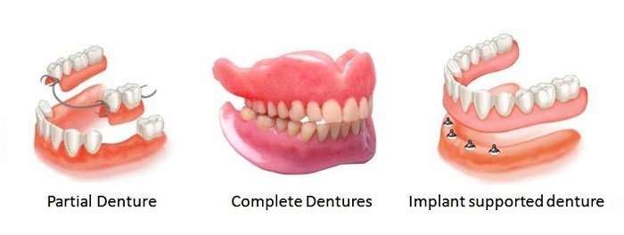 types of dentures