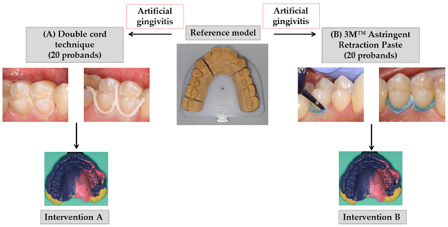 types of gingival retraction materials